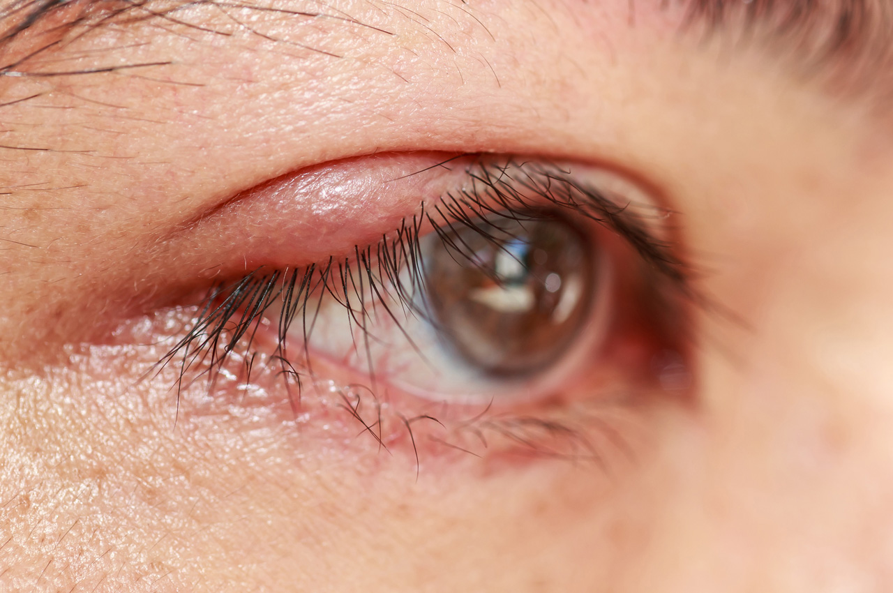 Clínica de olhos Levate - 👀 Terçol ou Hordéolo: 1. O que é? Pequeno nódulo  infeccioso na região palpebral, mais precisamente na base dos cílios.  Geralmente ocorre por uma obstrução das glândulas