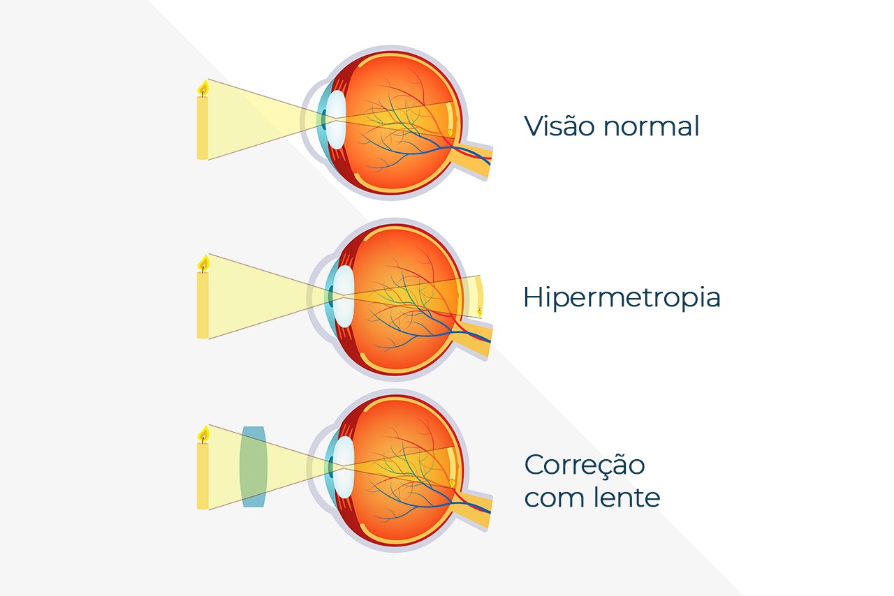 Presbiopia: O que é e por que temos esse problema na visão?